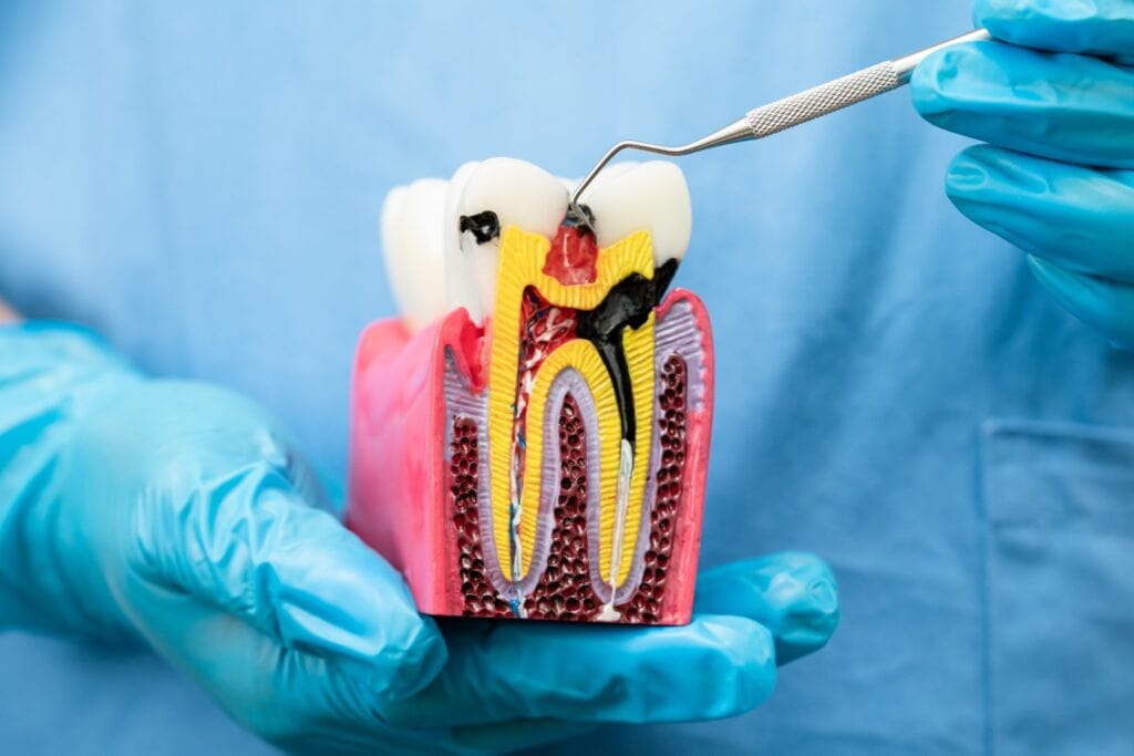 Modèle de dent avec carie avancée - Soins de dentisterie esthétique Odontys