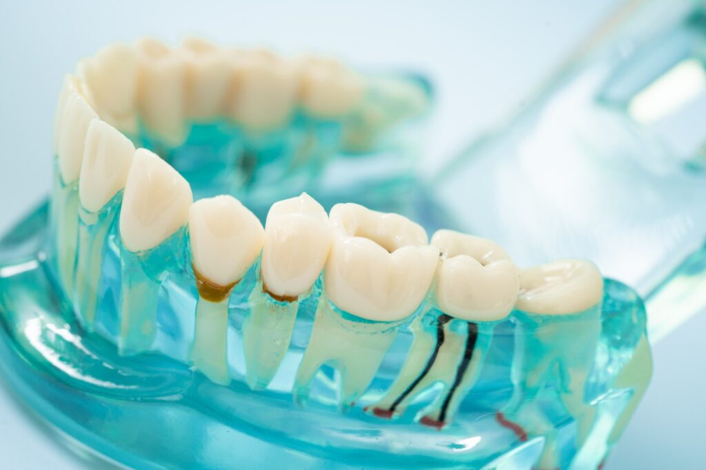 Modèle dentaire montrant un traitement de canal en endodontie
