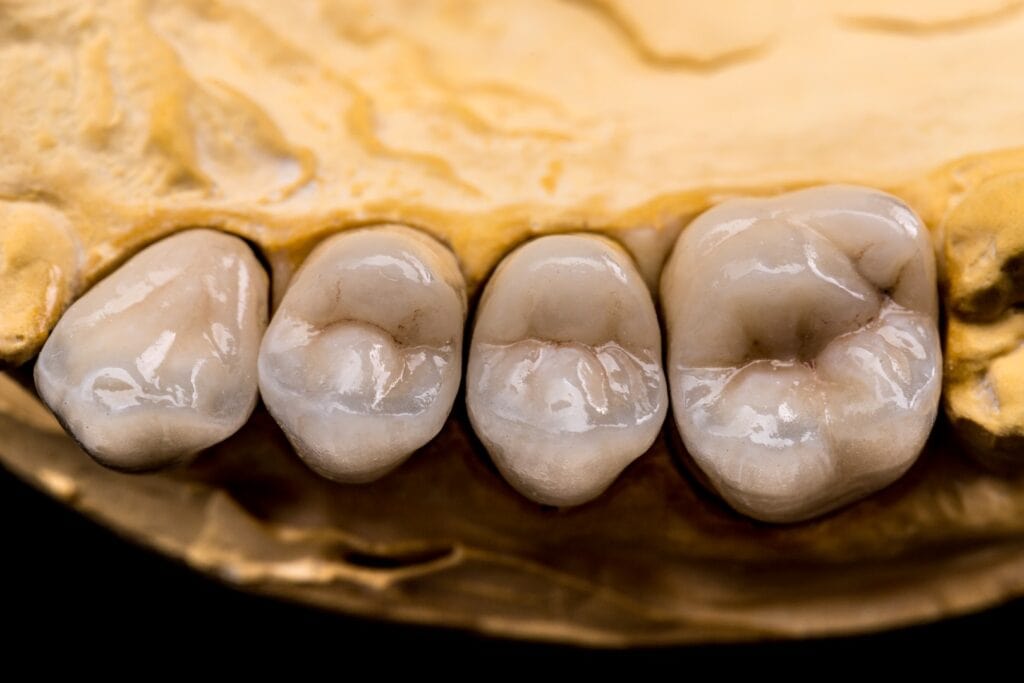 Couronnes dentaires en céramique sur modèle - Soins de dentisterie esthétique Odontys
