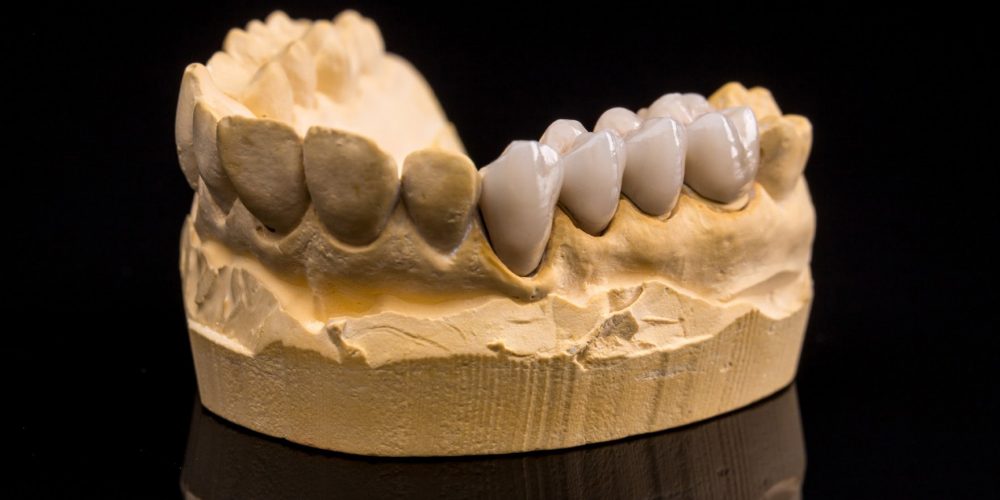 Modèle en plâtre de la mâchoire montrant un pont dentaire de plusieurs unités remplaçant des dents manquantes.